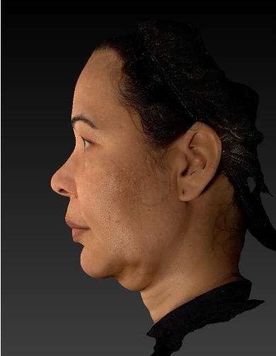 Hifu Ultraformer MPT Full Face, Chin and Neck before treatment