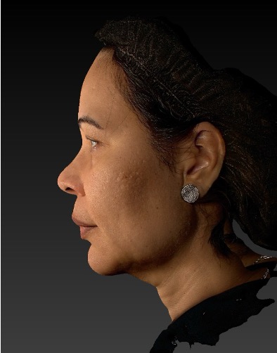 Hifu Ultraformer MPT Full Face, Chin and Neck after treatment