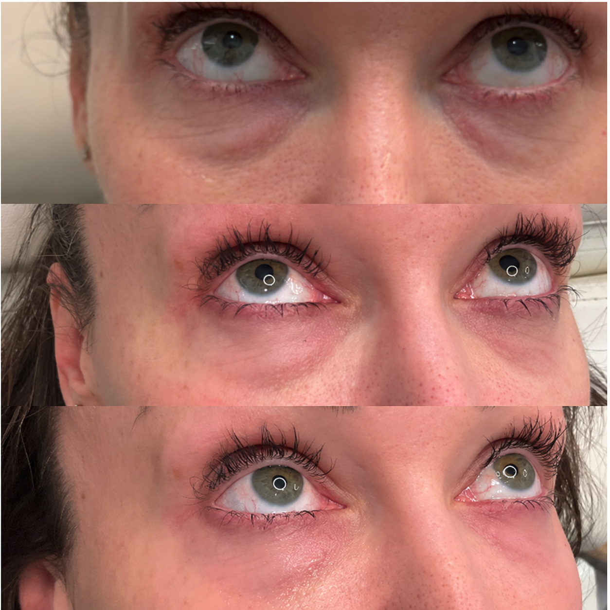 Eye area before Rejuran treatment