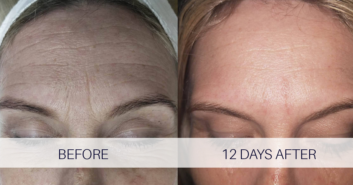 Supplier-provided forehead before-and-after clinical image