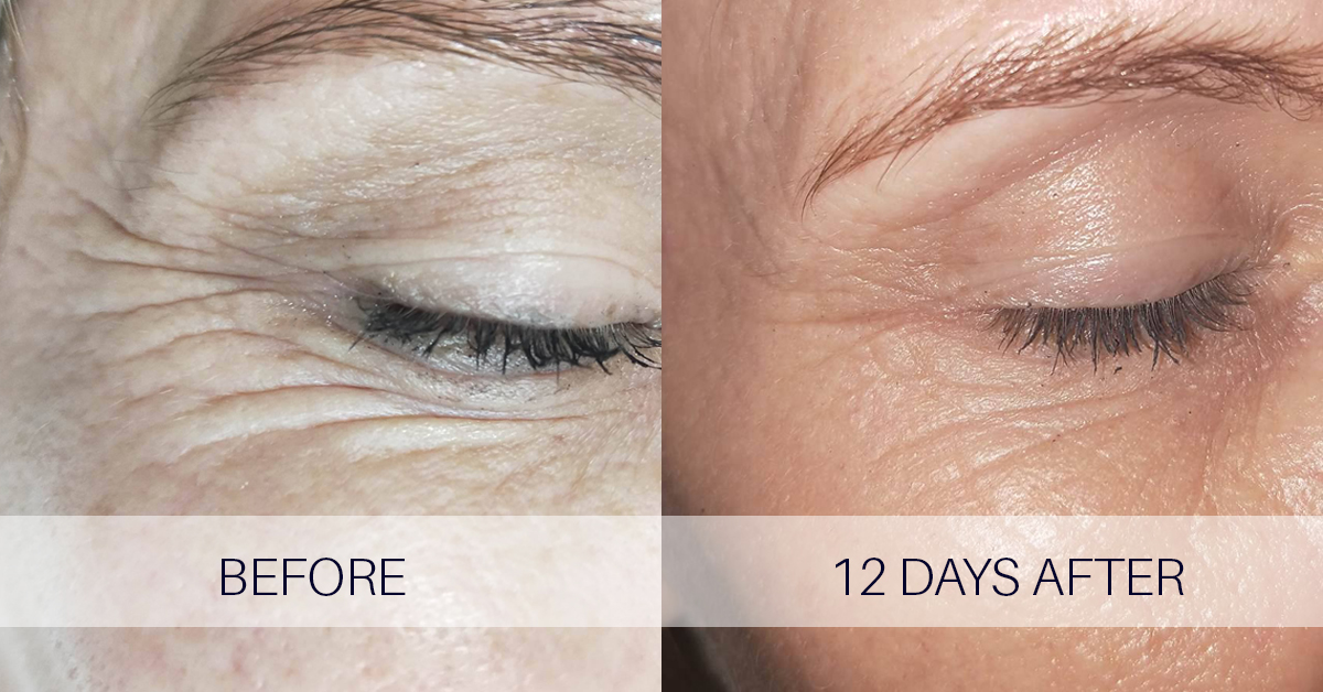 Supplier-provided outer-eye before-and-after clinical image