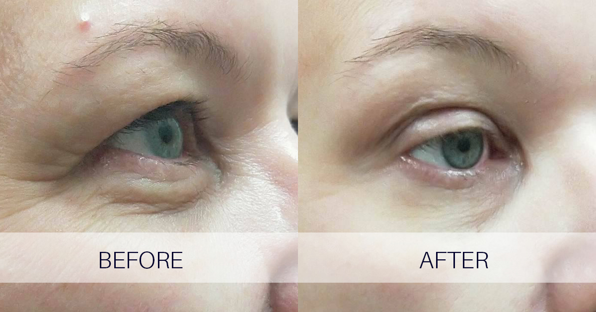 Supplier-provided eye-area before-and-after clinical image