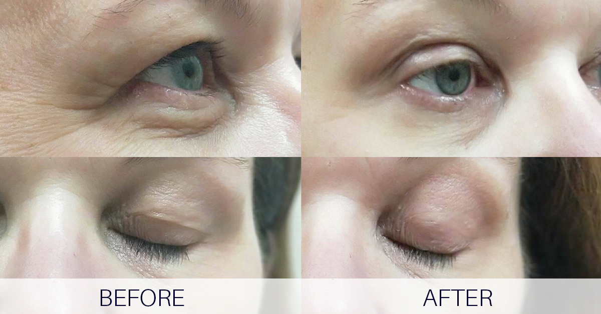 Supplier-provided eyelid before-and-after clinical image